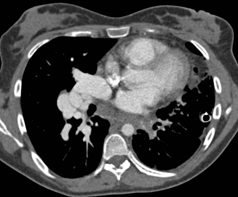 Arteriovenous (AV) Shunting Right Lung Simulating a Mass with a Pulmonary Arteriovenous Malformation (PAVM) Appearance. Compare Flow in Right and Left Lung - CTisus CT Scan