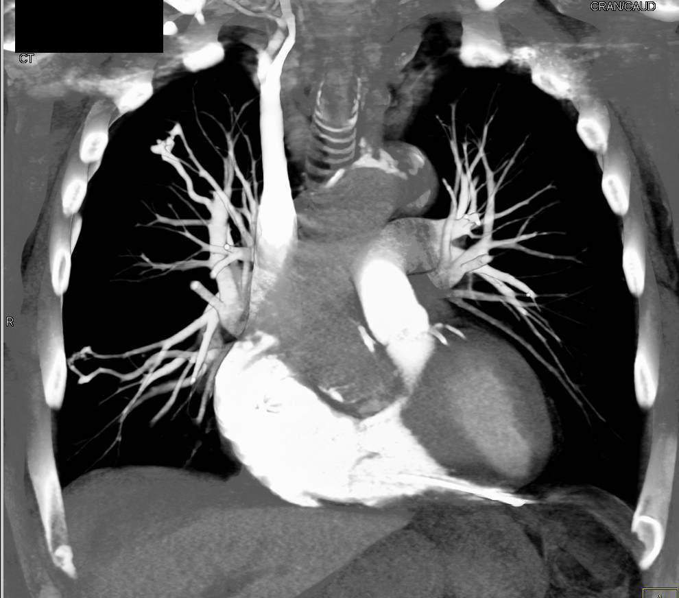 Hereditary Hemorrhagic Telangiectasia (HHT) with Multiple Pulmonary Arteriovenous Malformations (AVMs) and Osler Weber Rendu Syndrome - CTisus CT Scan