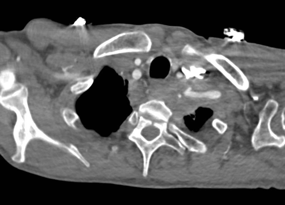 Apical Lung Cancer - CTisus CT Scan