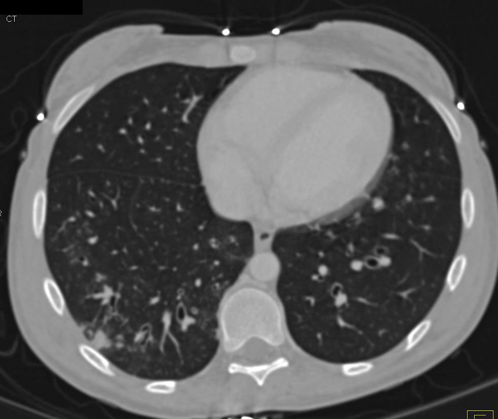Bronchiectasis and Bronchiolitis - CTisus CT Scan