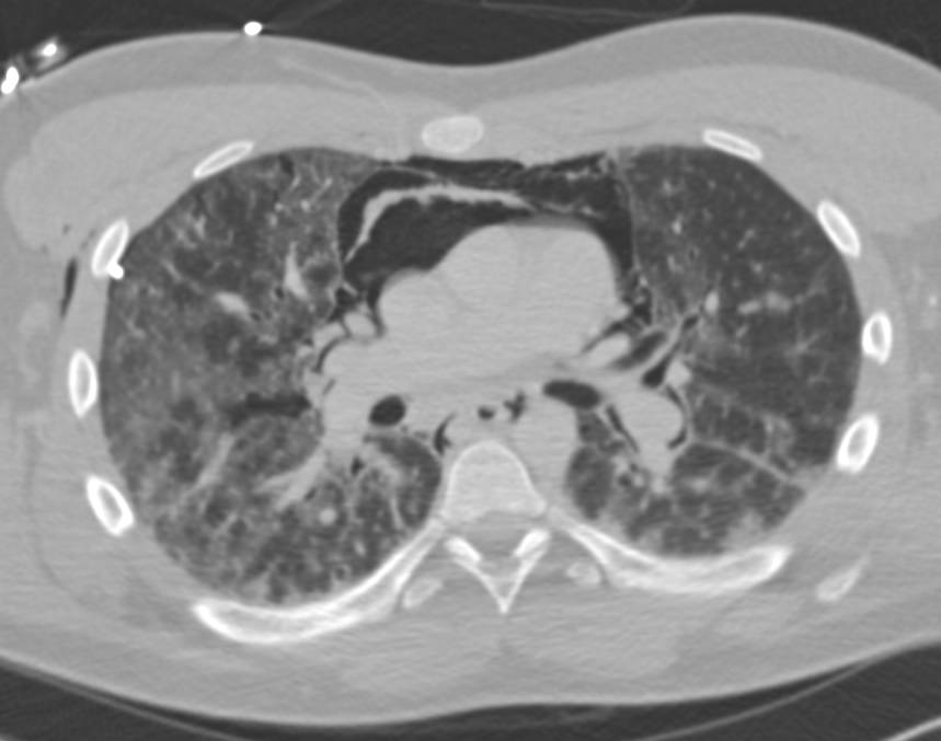 Pneumomediastinum and Interstitial Lung Disease (ILD) - CTisus CT Scan