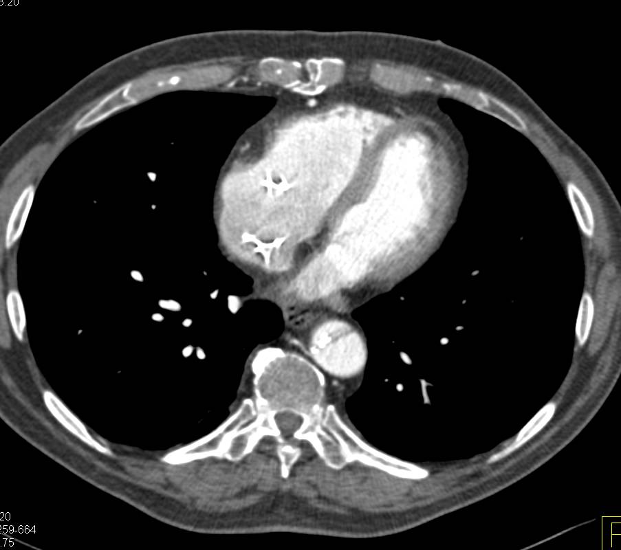 Beautiful Type A Aortic Dissection - CTisus CT Scan