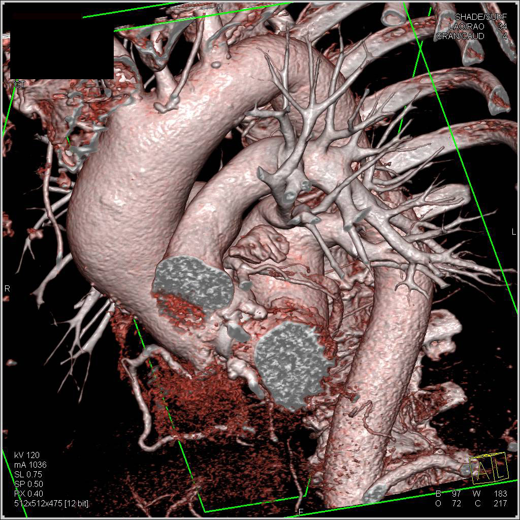 CTA of Dilated Ascending Aorta and AVR (Aortic Valve Replacement) - CTisus CT Scan