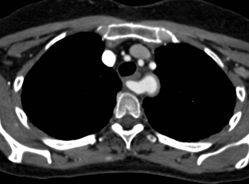 Aberrant Right Subclavian Artery in 3D - CTisus CT Scan