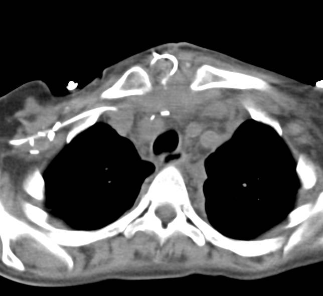 Active Extravasation from Aortic Root Following Aortic Valve Replacement (AVR) and Root Repair - CTisus CT Scan