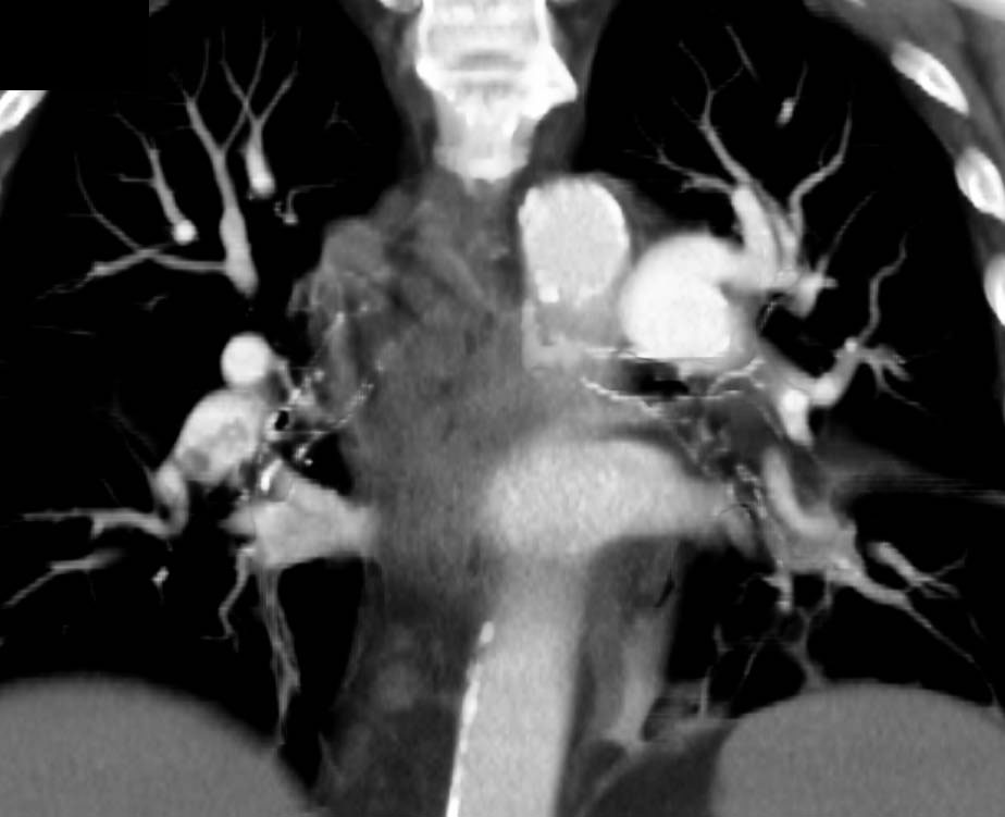 Chronic Pulmonary Embolism Right Main Pulmonary Artery with Calcification - CTisus CT Scan