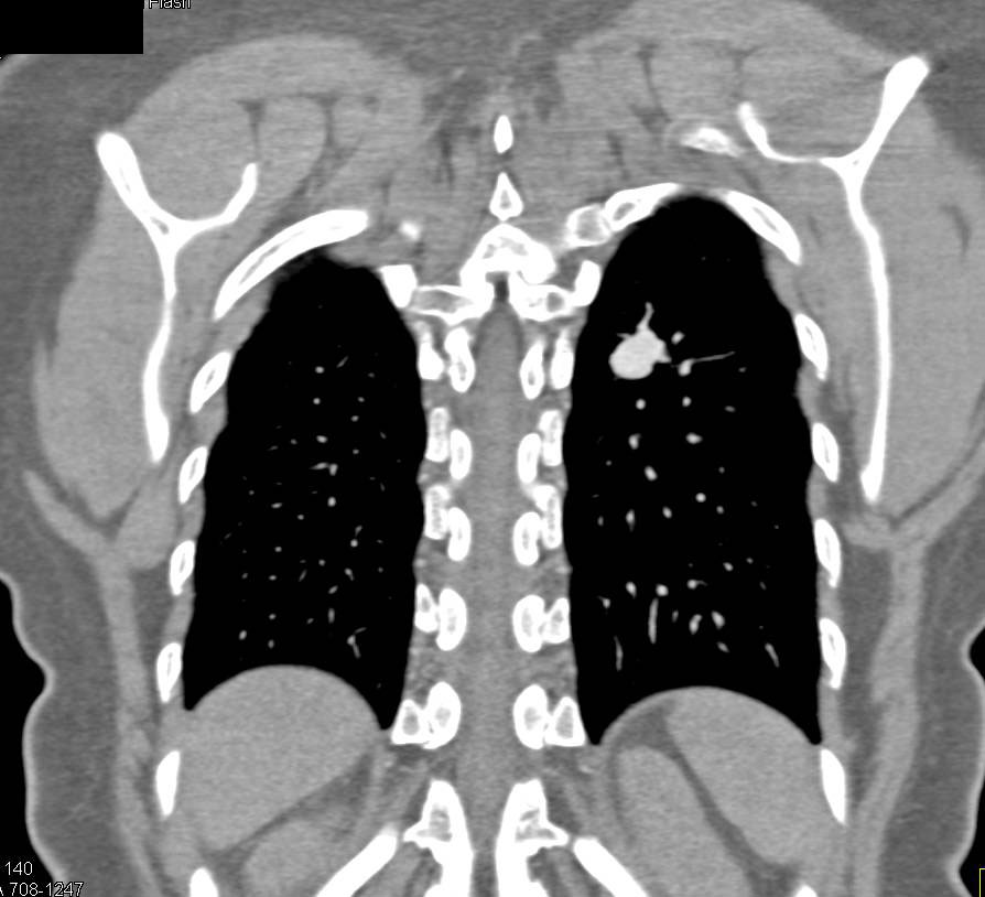 Pulmonary Arteriovenous Malformation (PAVM) - CTisus CT Scan