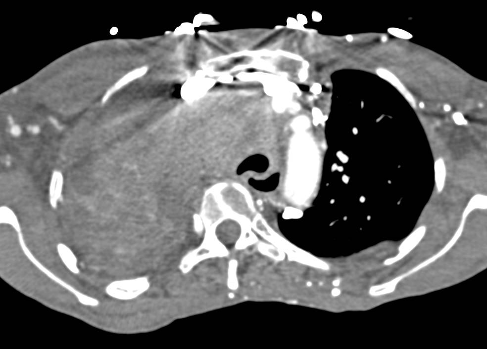 Superior Vena Cava (SVC) Syndrome with Collaterals in Patient with Non-Small Cell Lung Cancer and Central Invasion - CTisus CT Scan