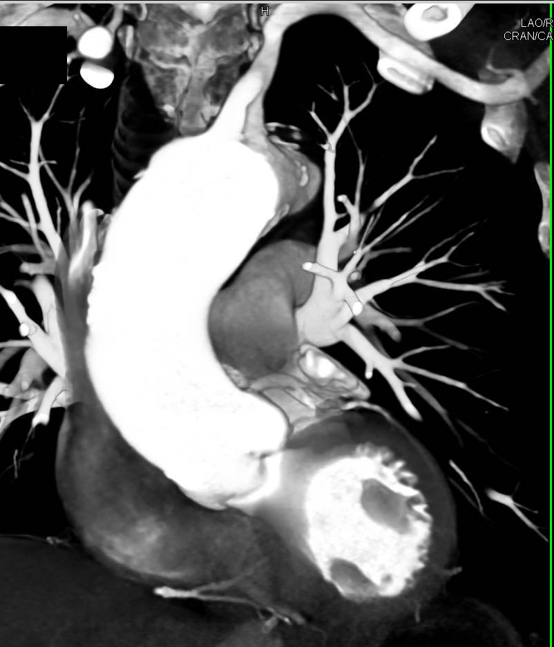 Dilated Ascending Aorta with Thickening of Aortic Valve Leaflets - CTisus CT Scan