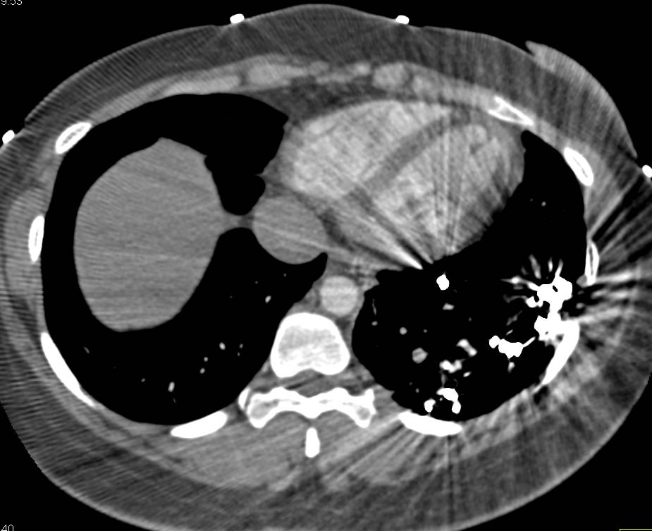 Embolization of Pulmonary Arteriovenous Malformation (PAVM) in Left Lower Lung Simulates a PE - CTisus CT Scan