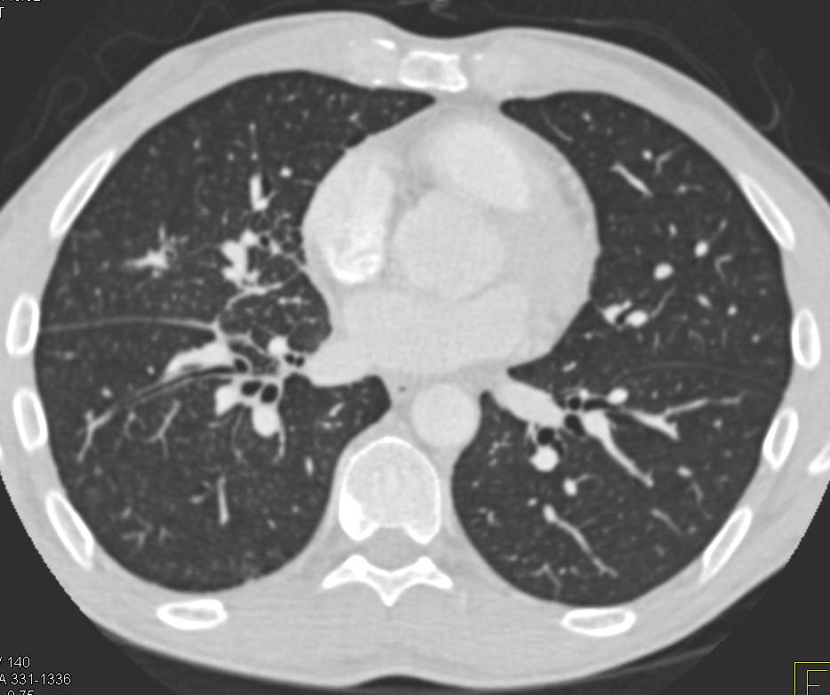 Nodule with Early Lymphangitic Spread near Right Hilum - CTisus CT Scan