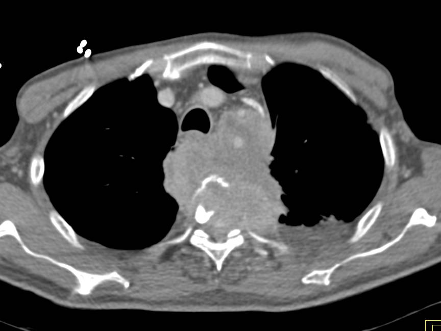 Lung Cancer Invades the Spine and Spinal Canal - CTisus CT Scan