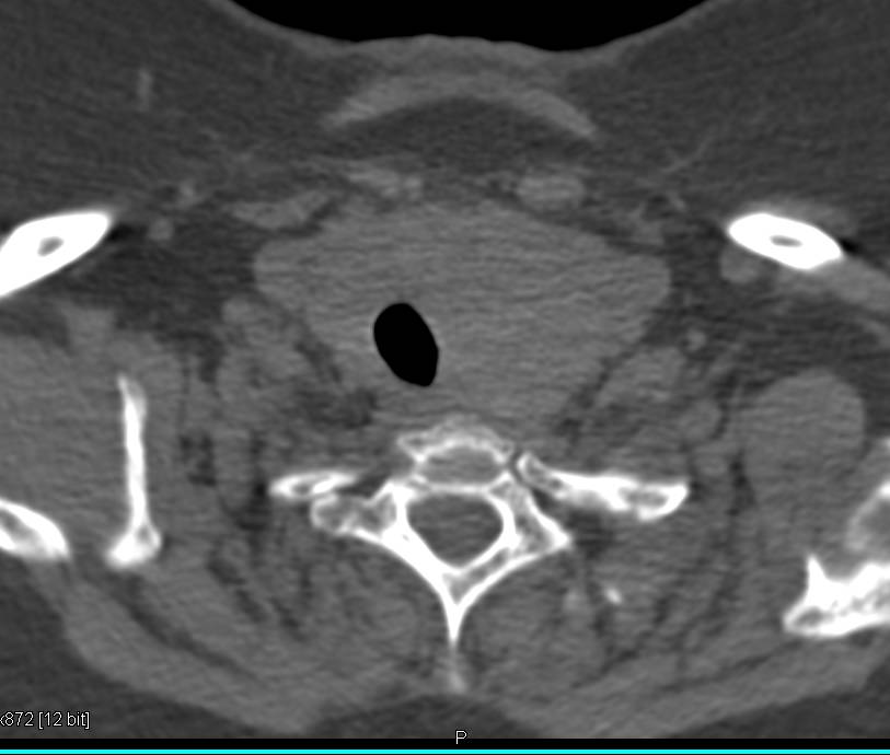 Thyroid Goiter Displaces the Trachea in 3D - CTisus CT Scan