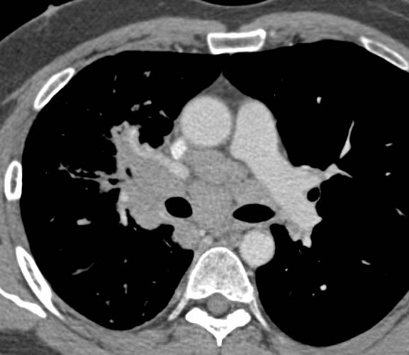 Renal Cell Carcinoma Metastatic to the Mediastinum - CTisus CT Scan