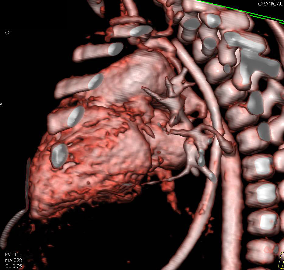Coarctation of the Aorta - CTisus CT Scan