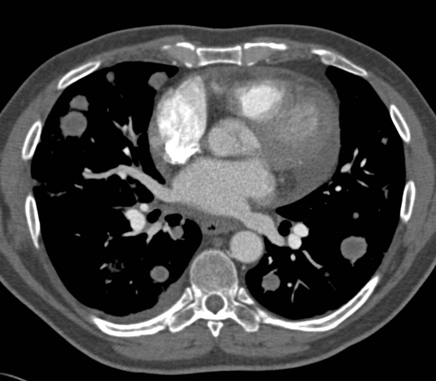 Sarcoma with Widespread Lung Metastases and Mediastinal Adenopathy - CTisus CT Scan