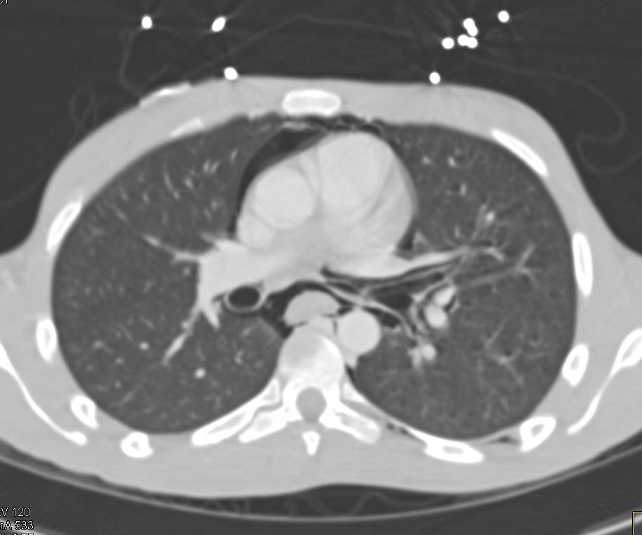 Spontaneous Pneumomediastinum - CTisus CT Scan