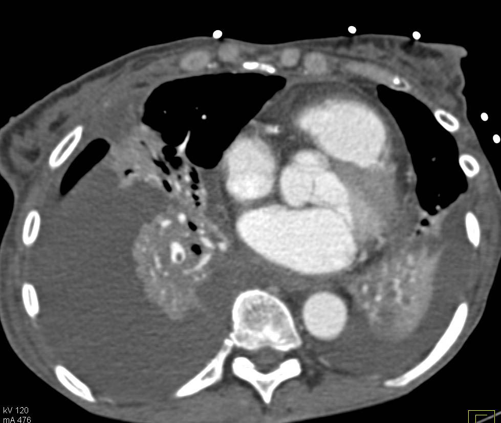 Pulmonary Embolism (PE) Seen in Consolidated Right Lower Lung is Easy to Miss - CTisus CT Scan