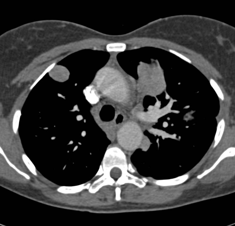 Lymphoma with Mediastinal, Lung Parenchymal and Renal Involvement - CTisus CT Scan