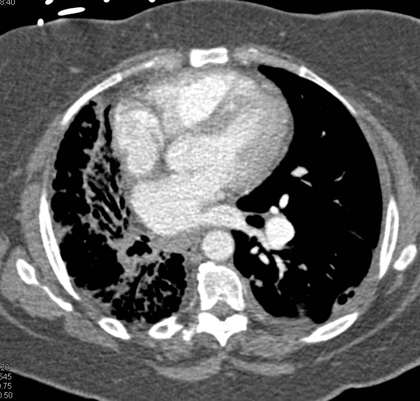 Honeycombing with Fibrosis Right Lung due to Sarcoidosis. Left Lung Transplant - CTisus CT Scan