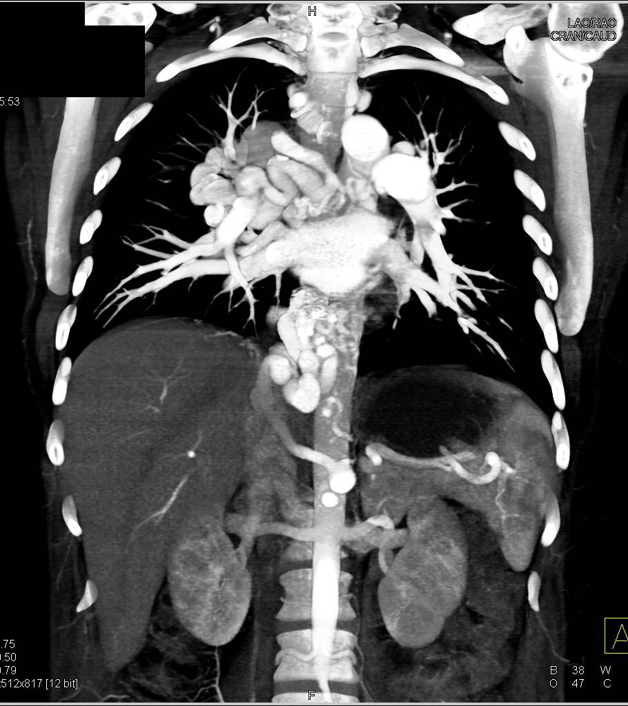 Huge Varices in Mediastinum and Right Hilum compatible with Pulmonary Arteriovenous Malformation (PAVM) - CTisus CT Scan