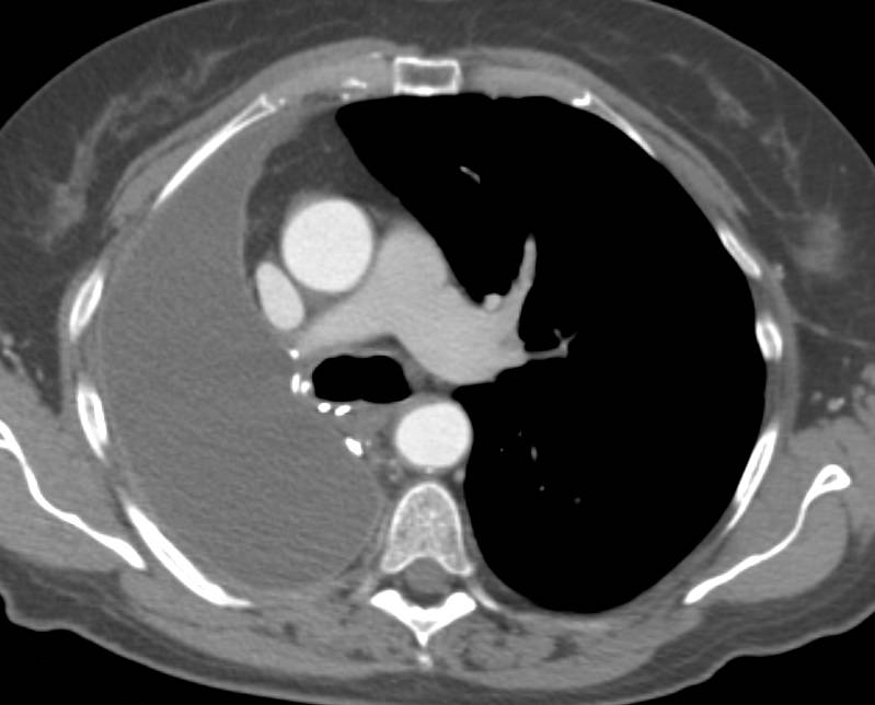 Small Cell Lung Cancer with Pneumonectomy and now Adrenal Metastases. PET Positive in Right Adrenal. - CTisus CT Scan