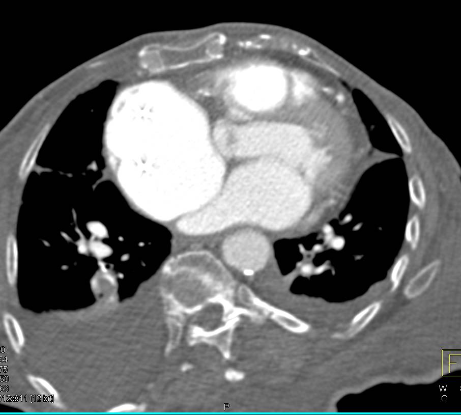 Poor Cardiac Function with New Pulmonary Embolism (PE) in Right Lower Lung Pulmonary Artery - CTisus CT Scan