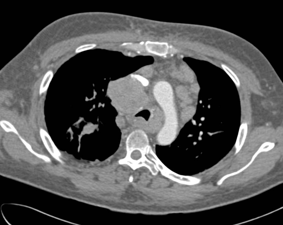 Developing Superior Vena Cava (SVC) Syndrome in a Patient with Non Small cell Lung Cancer. See the MIP Images for SVC Narrowing - CTisus CT Scan