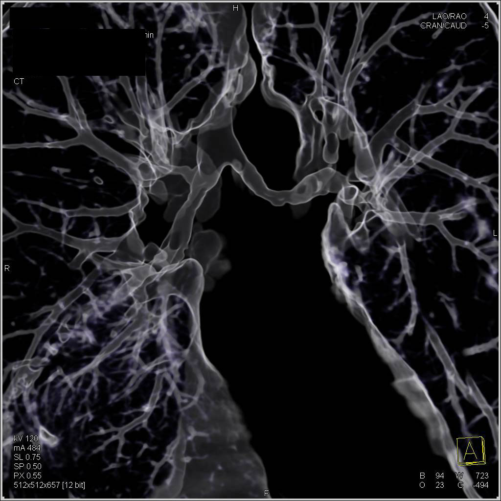 Narrowing of the Mainstem Bronchi in Wegener's Granulomatosis (Granulomatosis With Polyangiitis) - CTisus CT Scan
