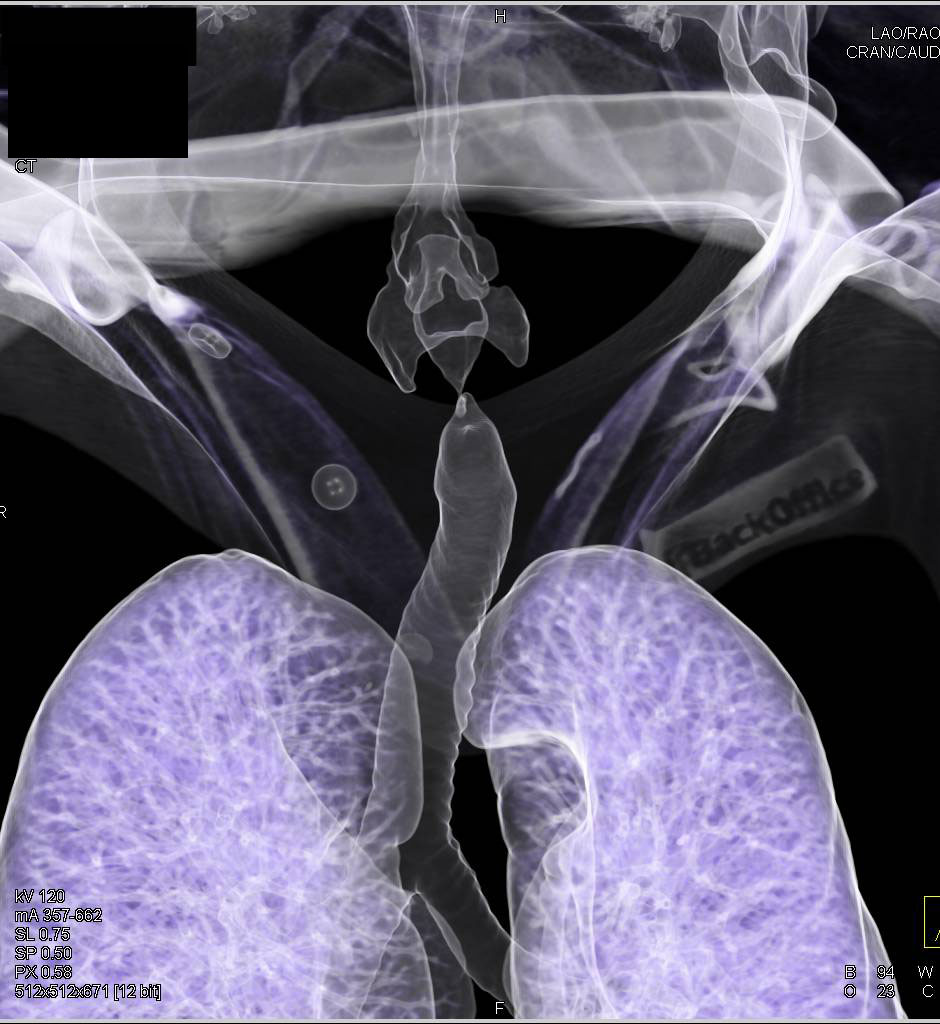 Virtual Bronchosopy with Subglottic Stenosis - CTisus CT Scan