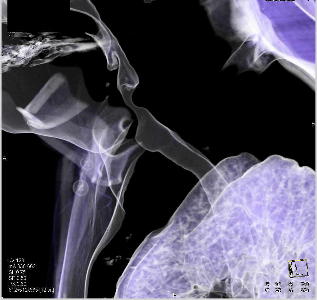 Virtual Bronchoscopy with Tracheal Stenosis due to Intubation - CTisus CT Scan