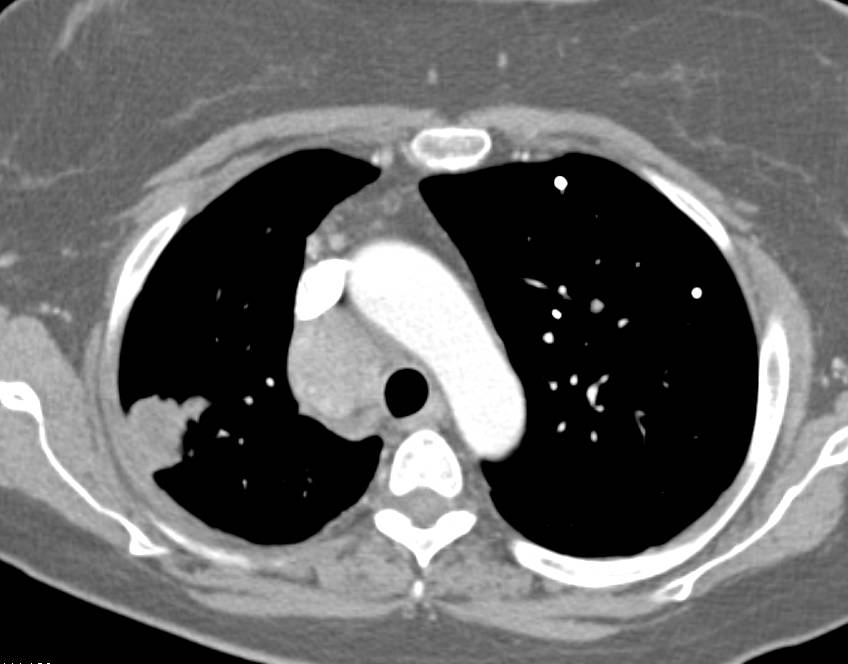 Metastatic Renal cell Carcinoma to Lung, Mediastinum and Spleen - CTisus CT Scan