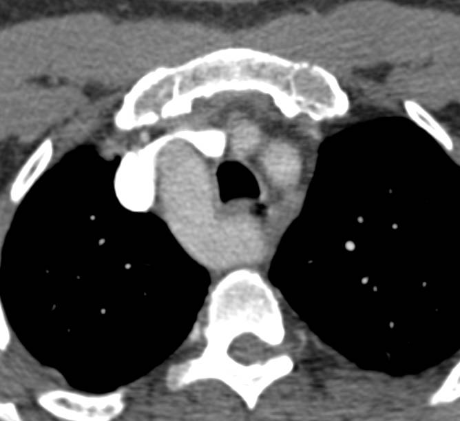 Double Aortic Arch with Compression of Trachea and Esophagus (Note the Ring) - CTisus CT Scan