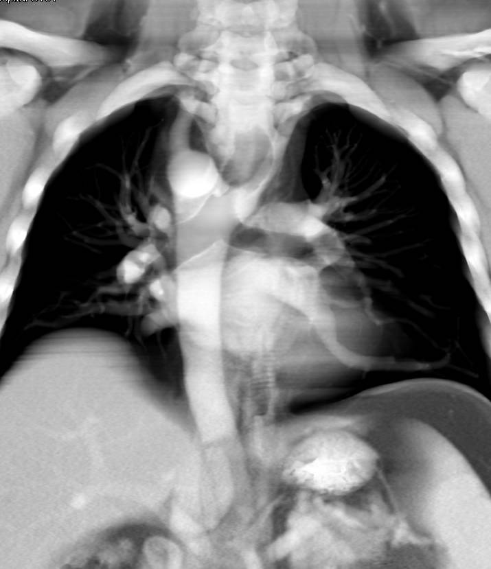 Right Aortic Arch with Aberrant Left Subclavian Artery - CTisus CT Scan