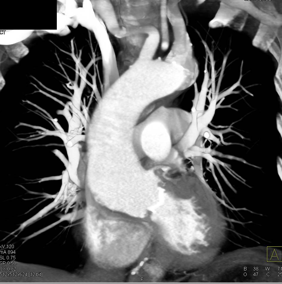 Dilated Ascending Aorta Analyzed with Vessel Tracking - CTisus CT Scan