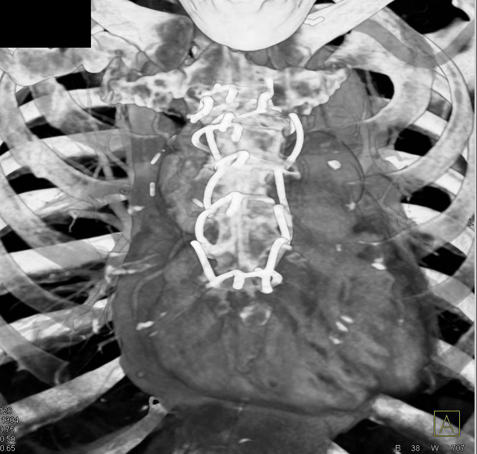 Sternal Wires Following Medial Sternotomy - CTisus CT Scan