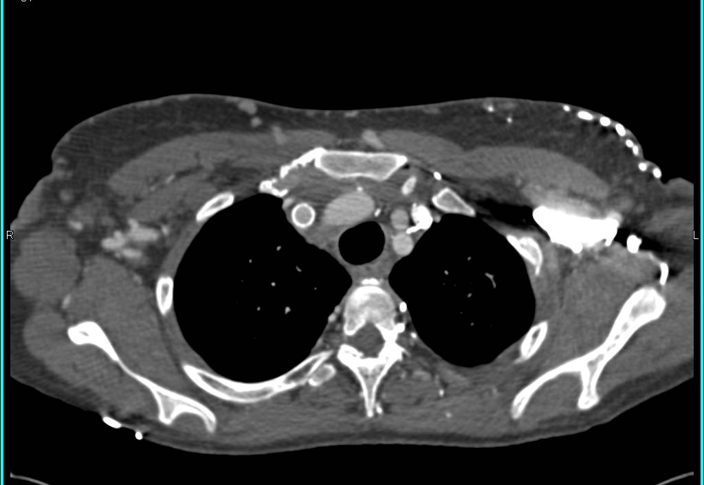 Superior Vena Cava (SVC) Occlusion with Stent Placed and Great Example of Collateral Flow Including a 