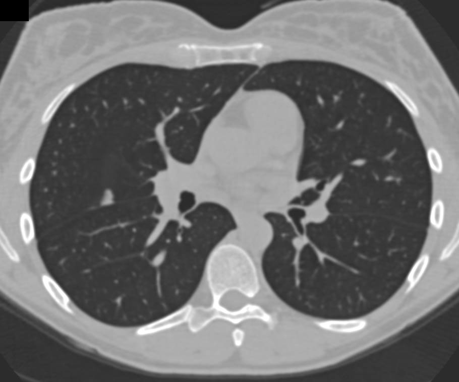 Focal Thickening in Fissure Simulates a Lung Nodule - CTisus CT Scan