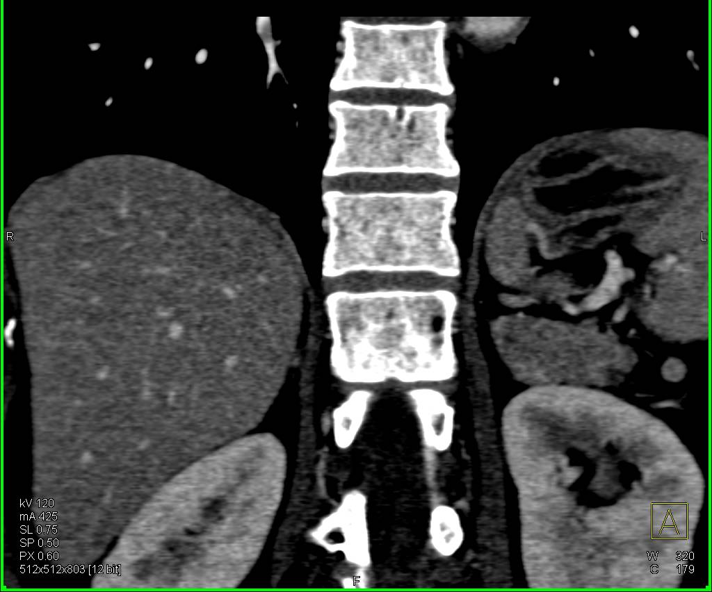 Subtle Pulmonary Embolism in Right Lower Lung - CTisus CT Scan