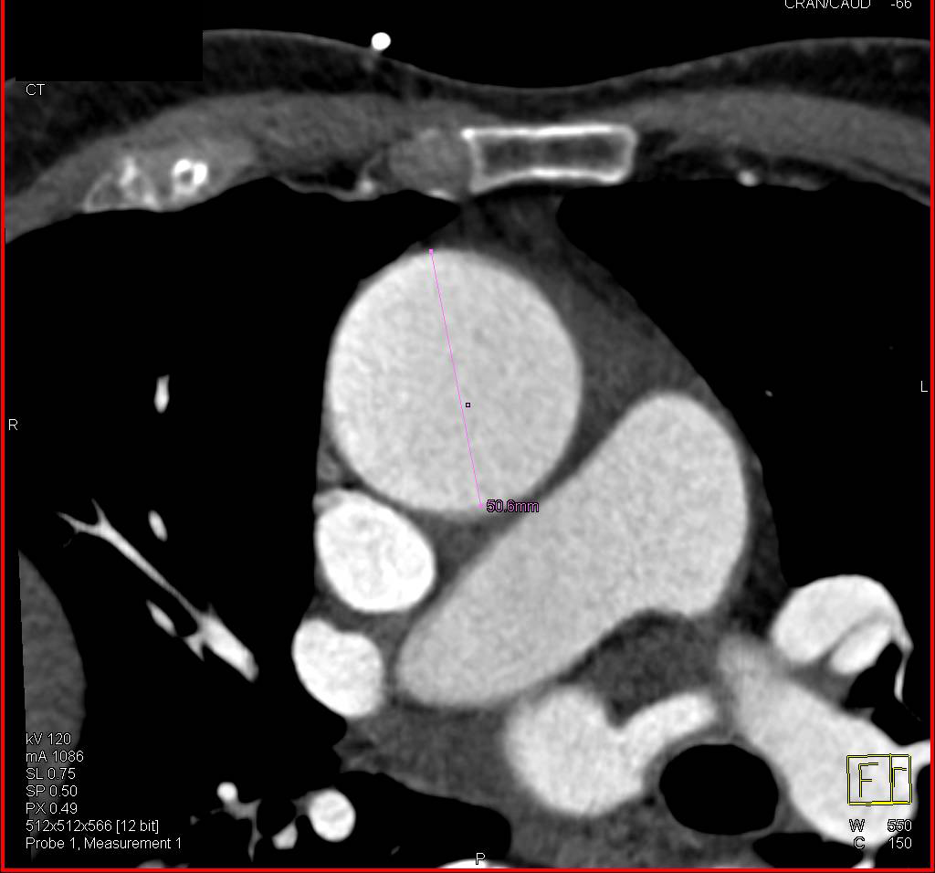 Dilated Aortic Root and Ascending Aorta - CTisus CT Scan