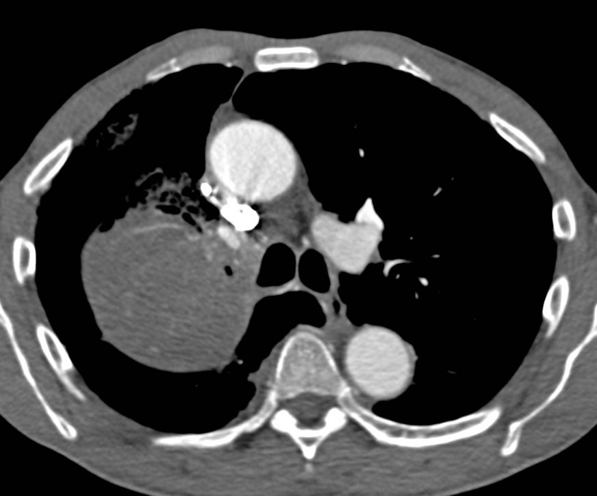 Non-Small Cell Lung Cancer (NSCLC) Encases the Right Upper Lobe Bronchus with Apical Extension - CTisus CT Scan