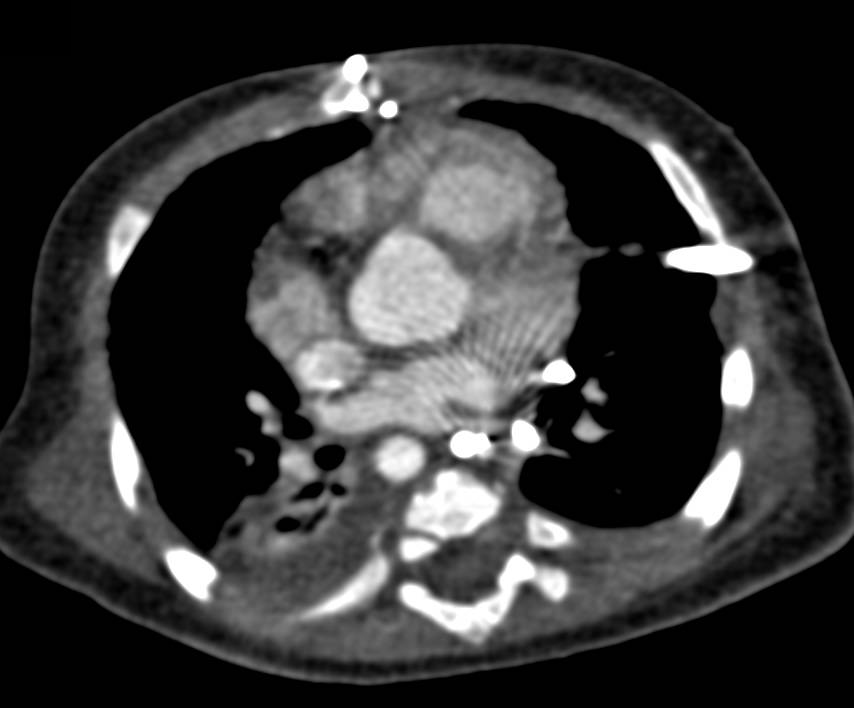 Right Sided Aortic Arch - CTisus CT Scan