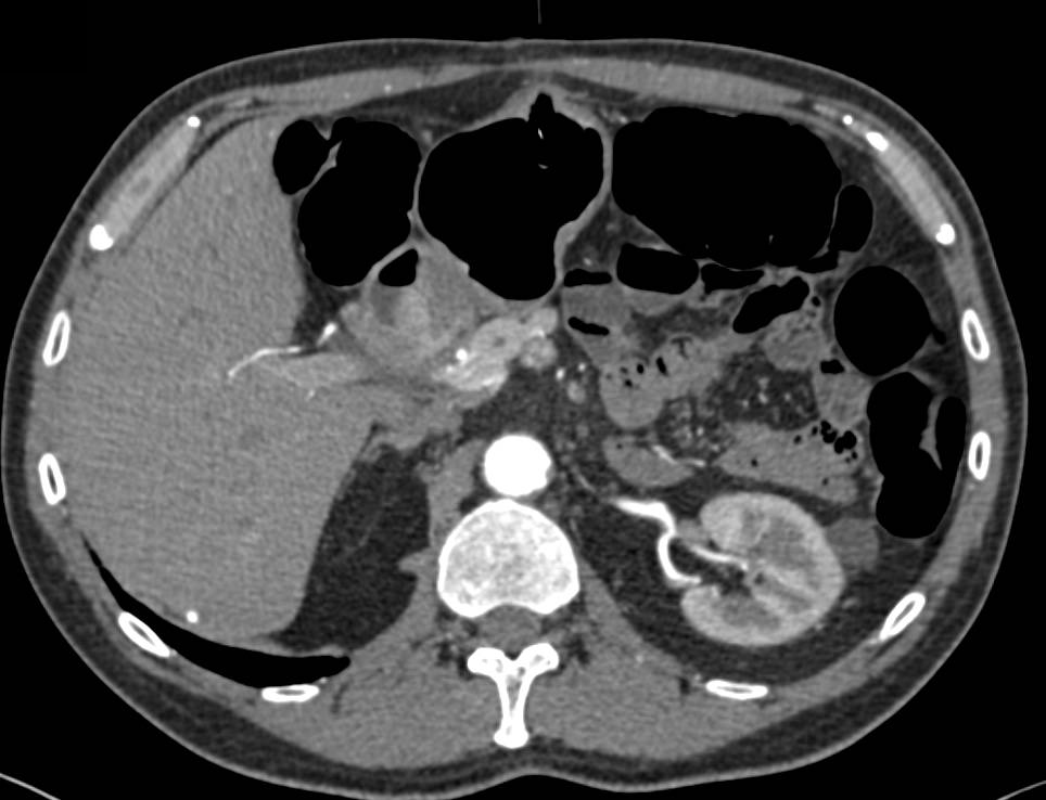 Elevated Left Hemidiaphragm due to Prior Trauma - CTisus CT Scan