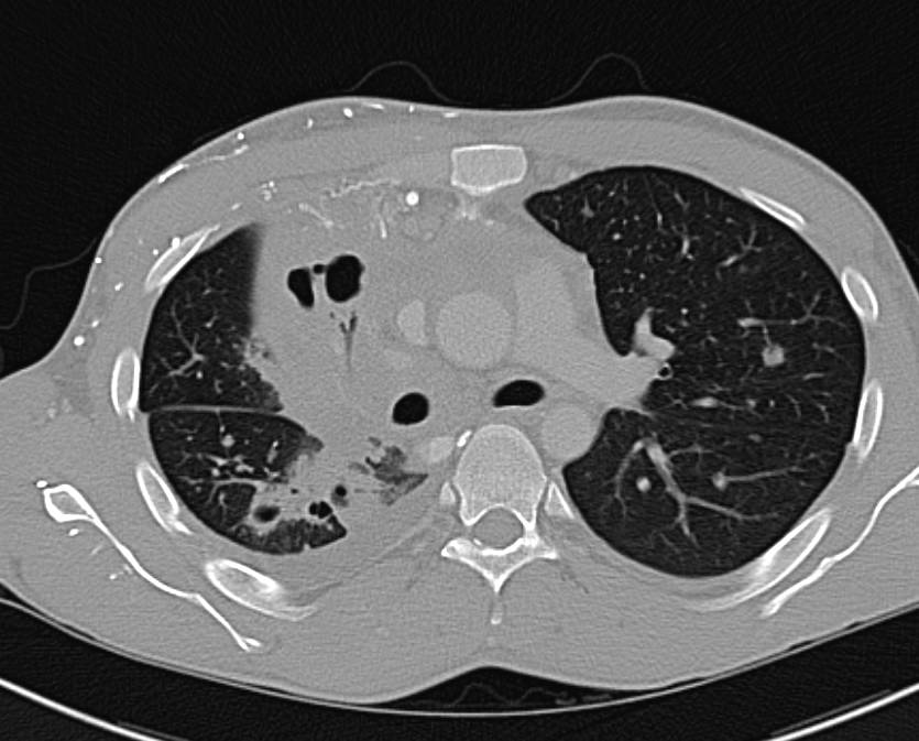 Non-Small Cell Lung Cancer (NSCLC) with Invasion of the Lung Parenchyma - CTisus CT Scan