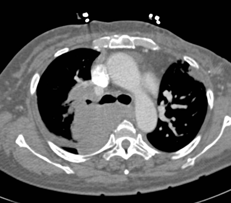 Small Cell Lung Cancer with Extensive Adenopathy - CTisus CT Scan
