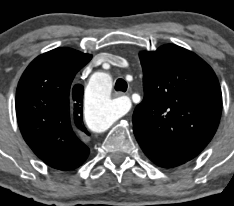 Right Aortic Arch with Aberrant Left Subclavian Artery - CTisus CT Scan