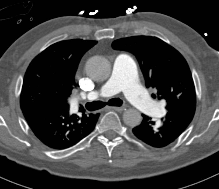 Perfectly Timed Pulmonary Embolism (PE) Study - CTisus CT Scan