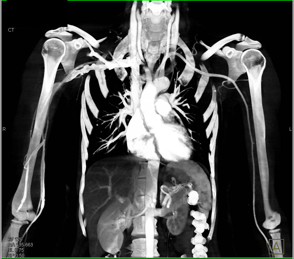Left Axillary Mass due to Breast Cancer seen in Multiple Perspectives - CTisus CT Scan