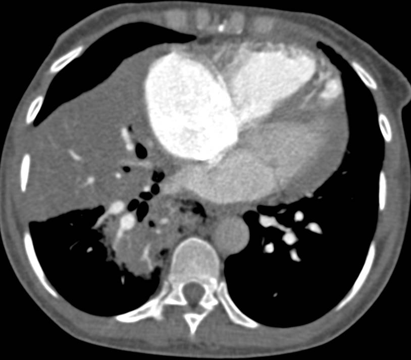 Hepatization of Right Lower Lung - CTisus CT Scan