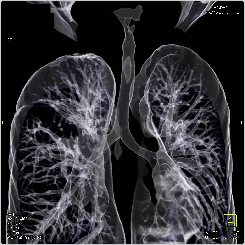Subglottic Stenosis due to Prior Intubation - CTisus CT Scan